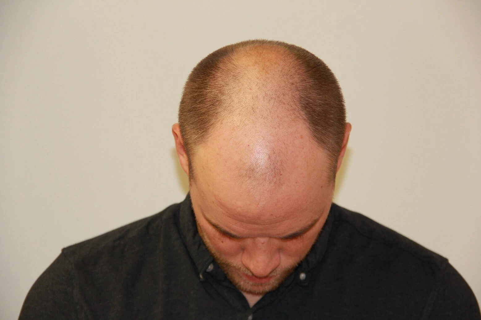 A man with a receding hairline is looking down, showcasing baldness on the top of his head. He is wearing a dark shirt, and the background is a light, neutral color. The image highlights the natural progression of hair loss, which can be common among men. This visual serves as a representation of male pattern baldness and can be relevant for discussions about hair loss treatments and confidence.